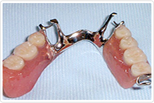 チタン床義歯